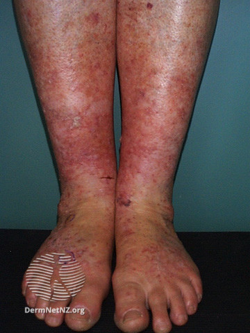 File:Actinic keratoses affecting the legs and feet (DermNet NZ lesions-ak-legs-560).jpg