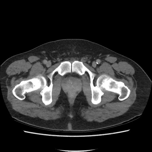 File:Active colonic bleed on CT (Radiopaedia 49765-55025 Axial C+ delayed 83).jpg