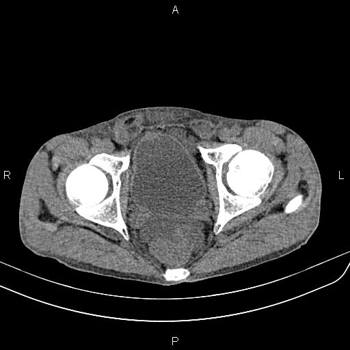 File:Active crohn disease (Radiopaedia 87133-103397 Axial non-contrast 96).jpg