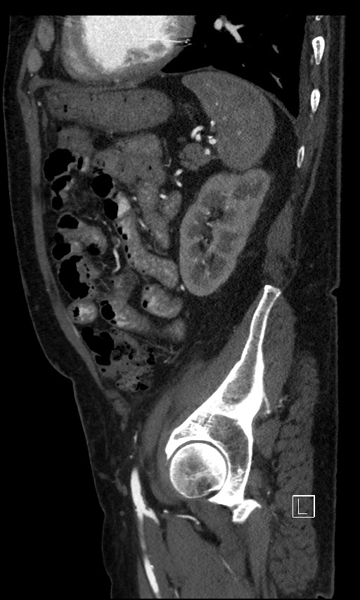 Active lower gastrointestinal bleeding - diverticular (Radiopaedia 61203-69106 Sagittal C+ arterial phase 43).jpg