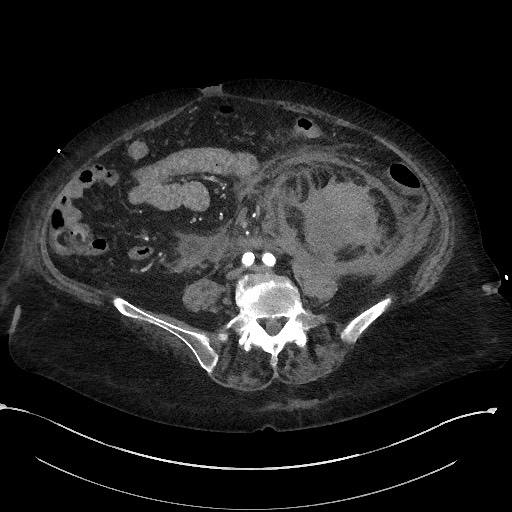 File:Active renal extravasation with large subcapsular and retroperitoneal hemorrhage (Radiopaedia 60975-68796 Axial 18).jpg