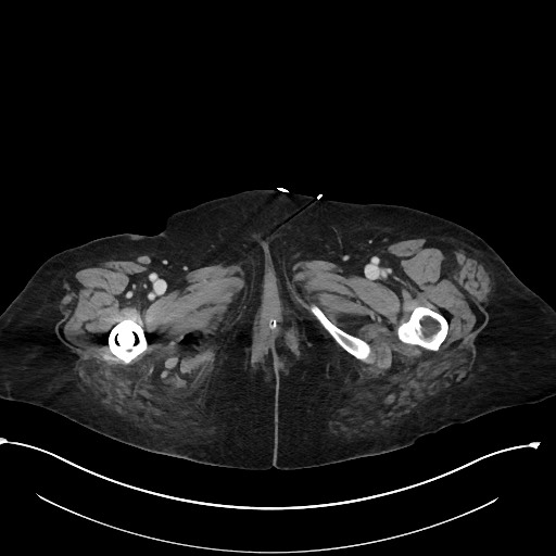 File:Active renal extravasation with large subcapsular and retroperitoneal hemorrhage (Radiopaedia 60975-68796 Axial 362).jpg