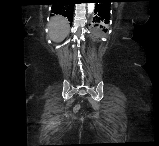 Active renal extravasation with large subcapsular and retroperitoneal hemorrhage (Radiopaedia 60975-68796 Coronal C+ arterial phase 123).jpg