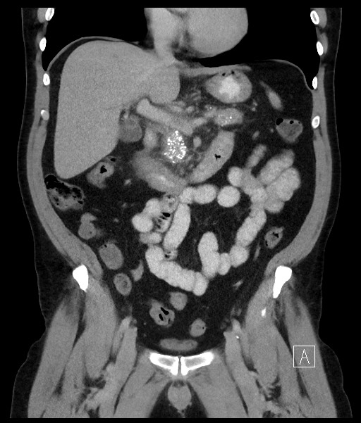 Acute-on-chronic pancreatitis (Radiopaedia 67286-76656 Coronal C+ portal venous phase 37).jpg