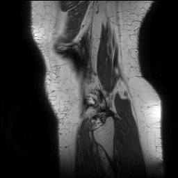File:Acute-on-chronic transient lateral patellar dislocation with trochlear dysplasia (Radiopaedia 84099-99349 Sagittal PD 144).jpg