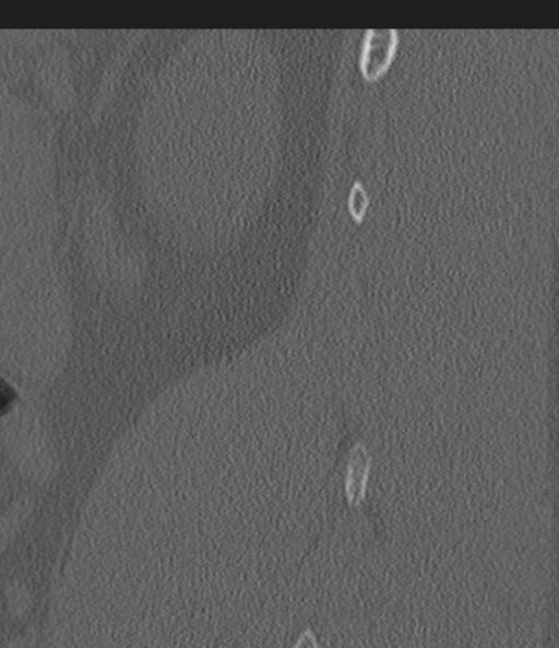 Acute L1 burst compression fracture (Radiopaedia 34430-35755 Sagittal bone window 57).png