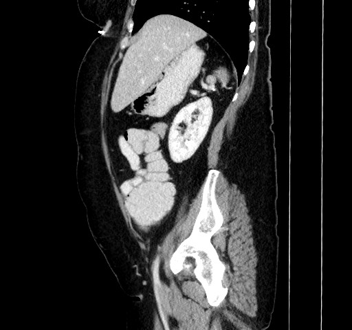 Acute appendicitis, heterotaxy syndrome (Radiopaedia 66884-76202 Sagittal C+ portal venous phase 45).jpg