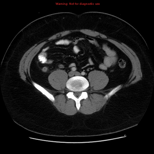 File:Acute appendicitis (Radiopaedia 12326-12607 Axial C+ portal venous phase 19).jpg