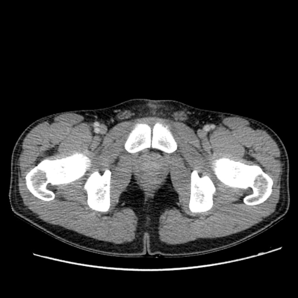 Acute appendicitis (Radiopaedia 27049-27227 Axial C+ portal venous phase 78).jpg