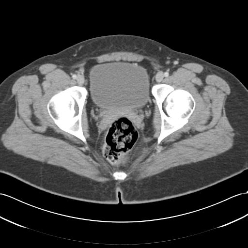 Acute appendicitis (Radiopaedia 30297-30934 Axial C+ portal venous phase 77).jpg