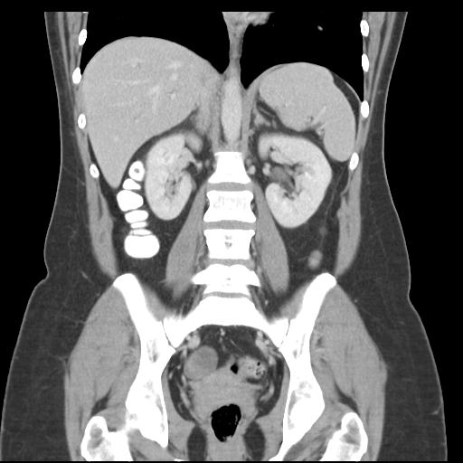 Acute appendicitis (Radiopaedia 30297-30934 Coronal C+ portal venous phase 29).jpg