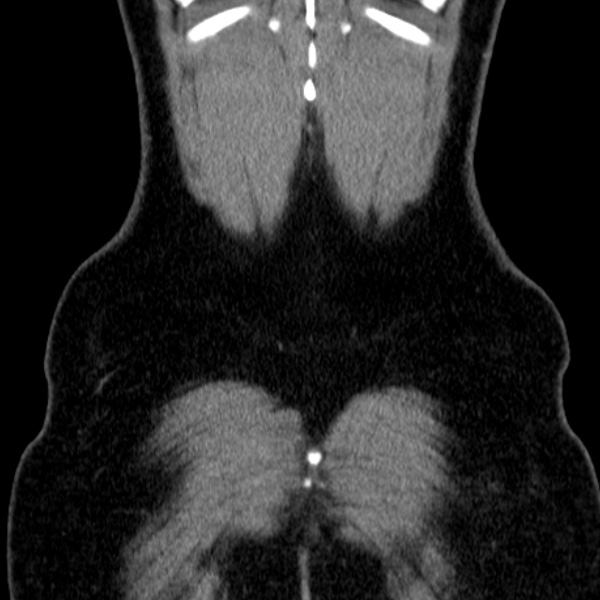 Acute appendicitis (Radiopaedia 38255-40270 Coronal C+ portal venous phase 84).jpg