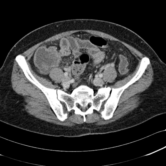 Acute appendicitis (Radiopaedia 48792-53822 Axial C+ portal venous phase 85).jpg