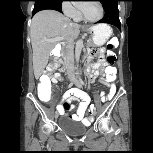 File:Acute appendicitis (Radiopaedia 52672-58589 Coronal C+ portal venous phase 46).jpg