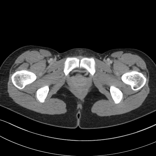 File:Acute appendicitis (Radiopaedia 62608-70901 Axial C+ portal venous phase 66).jpg