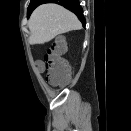 Acute appendicitis (Radiopaedia 66513-75790 Sagittal C+ portal venous phase 21).jpg