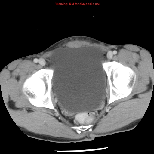 Acute appendicitis (Radiopaedia 8195-9045 Axial C+ portal venous phase 71).jpg