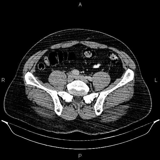 Acute appendicitis (Radiopaedia 84780-100240 Axial C+ portal venous phase 77).jpg
