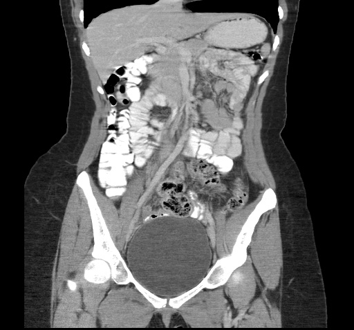 File:Acute appendicitis (Radiopaedia 9417-10099 Coronal C+ portal venous phase 9).jpg