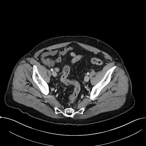 File:Acute appendicitis - large appendicoliths (Radiopaedia 61805-69820 Axial 56).jpg