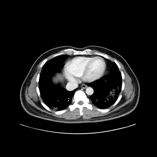 Acute appendicitis and COVID 19 pneumonia (Radiopaedia 76604-88380 Axial C+ portal venous phase 3).jpg