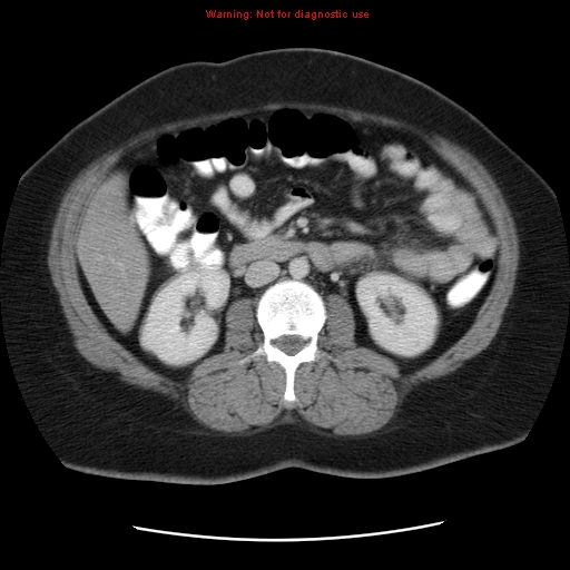 Acute appendicitis complicated by ovarian vein thrombophlebitis (Radiopaedia 16172-15851 Axial C+ portal venous phase 45).jpg