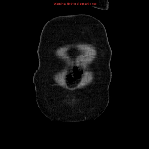 Acute appendicitis complicated by ovarian vein thrombophlebitis (Radiopaedia 16172-15851 Coronal C+ portal venous phase 8).jpg