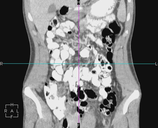 File:Acute appendicitis with CT arrowhead sign (Radiopaedia 21474-21411 Coronal C+ portal venous phase 3).JPG