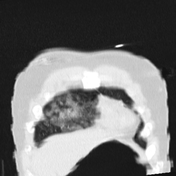 Acute aspiration pneumonitis (Radiopaedia 33605-34703 Coronal lung window 15).jpg