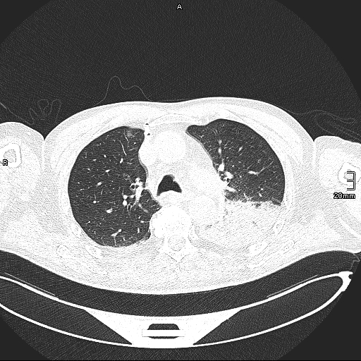 Acute aspiration pneumonitis (Radiopaedia 55642-62166 Axial lung window 59).jpg