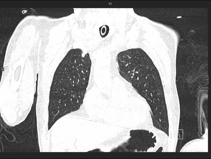 Acute aspiration pneumonitis (Radiopaedia 55642-62166 Coronal lung window 27).jpg