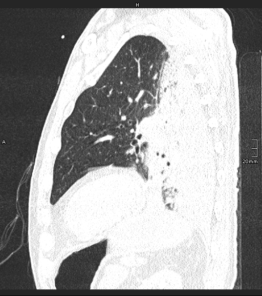 Acute aspiration pneumonitis (Radiopaedia 55642-62166 Sagittal lung window 39).jpg
