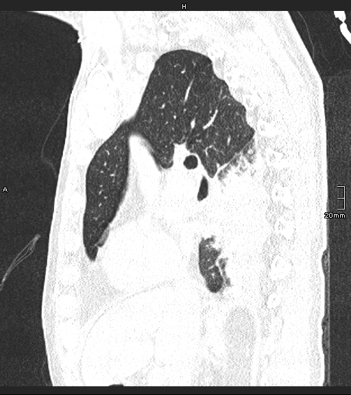 Acute aspiration pneumonitis (Radiopaedia 55642-62166 Sagittal lung window 94).jpg