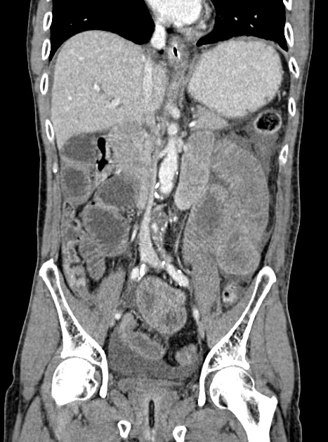 Acute bowel ischemia (Radiopaedia 87695-104114 Coronal C+ portal venous phase 208).jpg