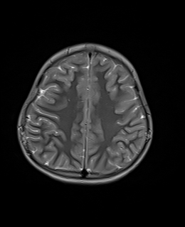 File:Acute cerebellar ataxia (Radiopaedia 61487-69446 Axial T2 17).jpg