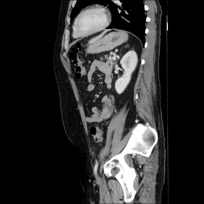 Acute cholecystitis and incidental left sided IVC (Radiopaedia 49352-54459 Sagittal C+ portal venous phase 33).jpg