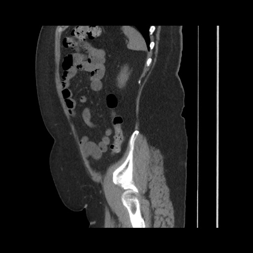 Acute cholecystitis with tensile fundus sign (Radiopaedia 71394-81723 Sagittal non-contrast 129).jpg