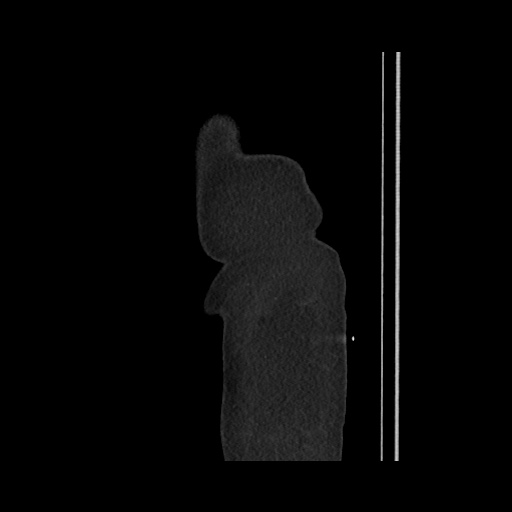 Acute cholecystitis with tensile fundus sign (Radiopaedia 71394-81723 Sagittal non-contrast 16).jpg