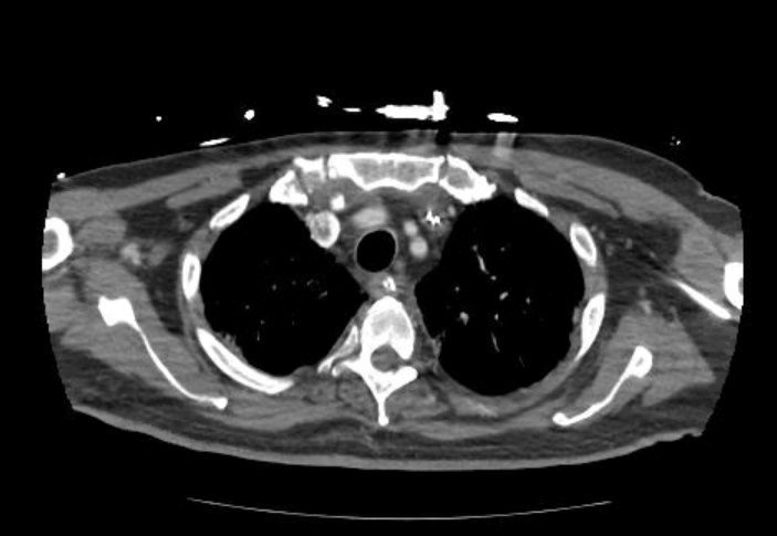 File:Acute cor pulmonale (ultrasound) (Radiopaedia 83508-98818 Axial 156).jpg