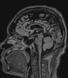 Acute disseminated encephalomyelitis (ADEM)- Anti-NMDA receptor encephalitis (Radiopaedia 54920-61201 Sagittal FLAIR 45).png