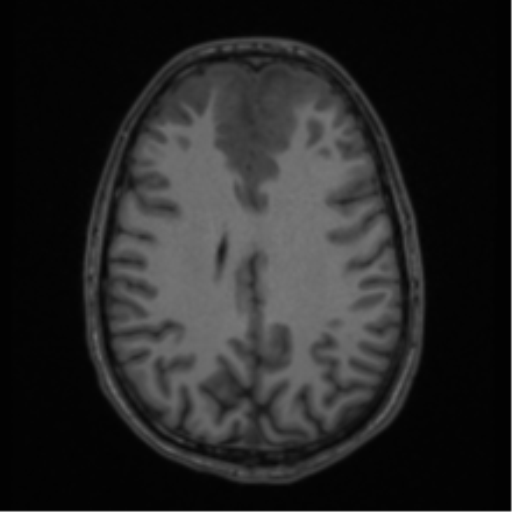 Acute disseminated encephalomyelitis (ADEM) (Radiopaedia 65319-74349 Axial T1 44).png
