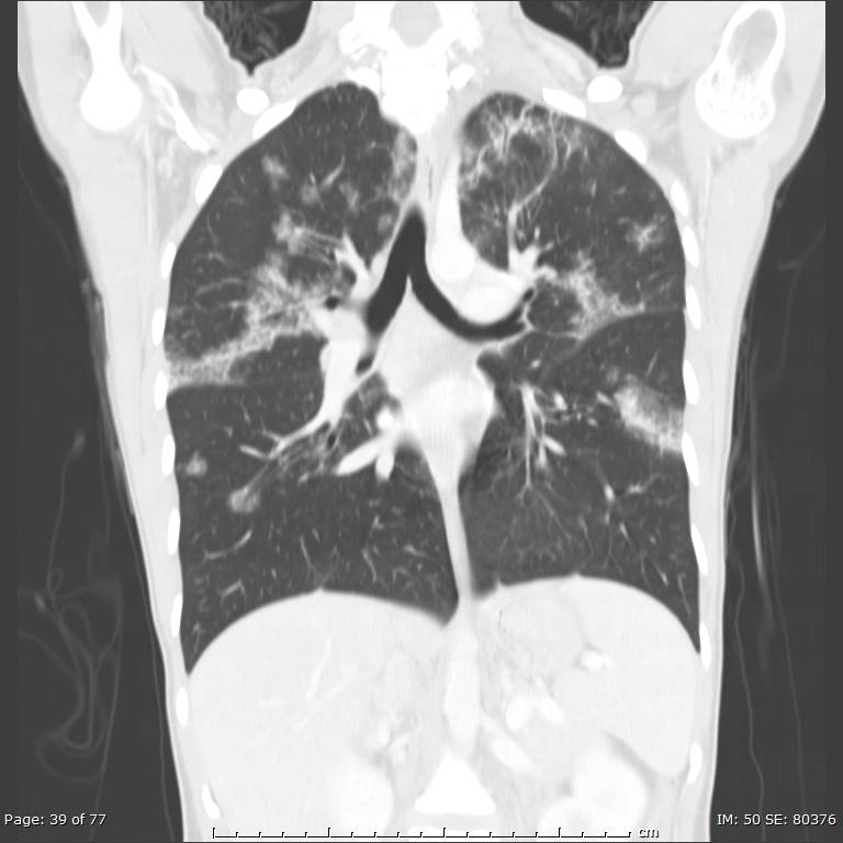 Acute eosinophilic pneumonia (Radiopaedia 48211-53073 Coronal lung window 26).jpg
