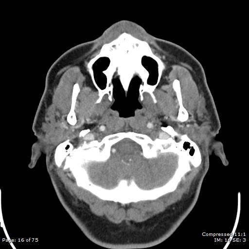 Acute epiglottitis (Radiopaedia 54375-60590 Axial C+ arterial phase 16).jpg