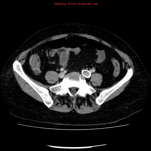 File:Acute gangrenous cholecystitis (Radiopaedia 10123-10661 Axial C+ portal venous phase 73).jpg