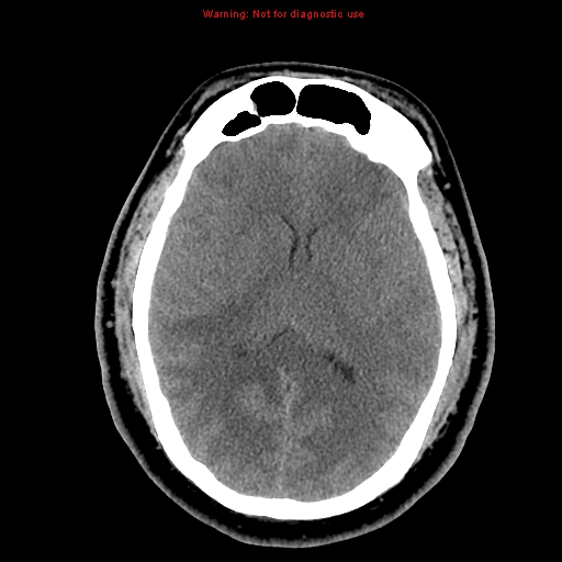 Acute hemorrhagic leukoencephalitis (Radiopaedia 14076-13920 Axial non-contrast 25).jpg