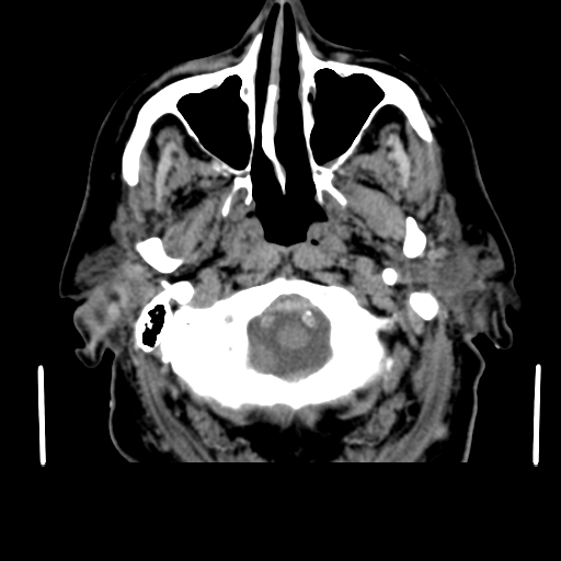 Acute hemorrhagic stroke (Radiopaedia 17507-17223 Axial non-contrast 6).jpg