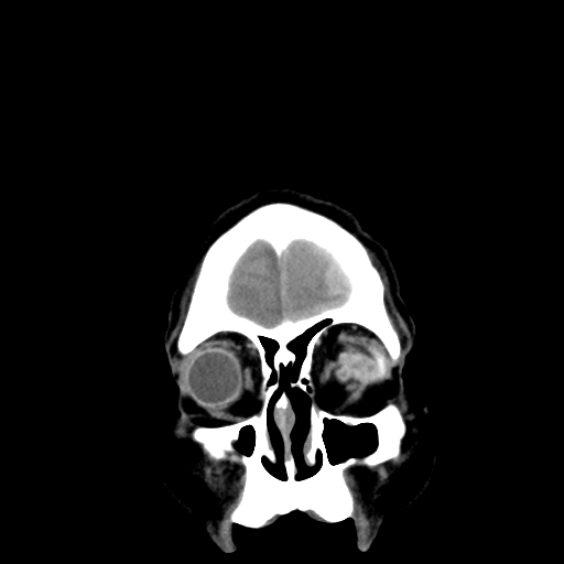 Acute hemorrhagic stroke (Radiopaedia 17507-17223 Coronal non-contrast 3).jpg