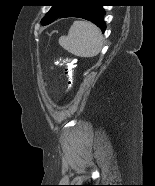 Acute mesenteric venous ischemia (Radiopaedia 46041-50383 Sagittal C+ portal venous phase 103).jpg
