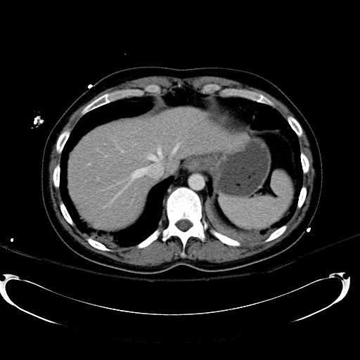 File:Acute myocardial infarction in CT (Radiopaedia 39947-42415 Axial C+ portal venous phase 20).jpg
