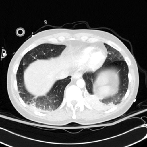 Acute myocardial infarction in CT (Radiopaedia 39947-42415 Axial lung window 109).jpg